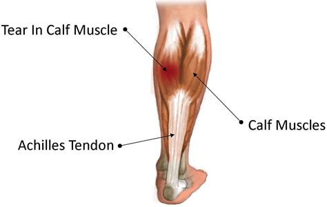 grade 4 gastrocnemius tear